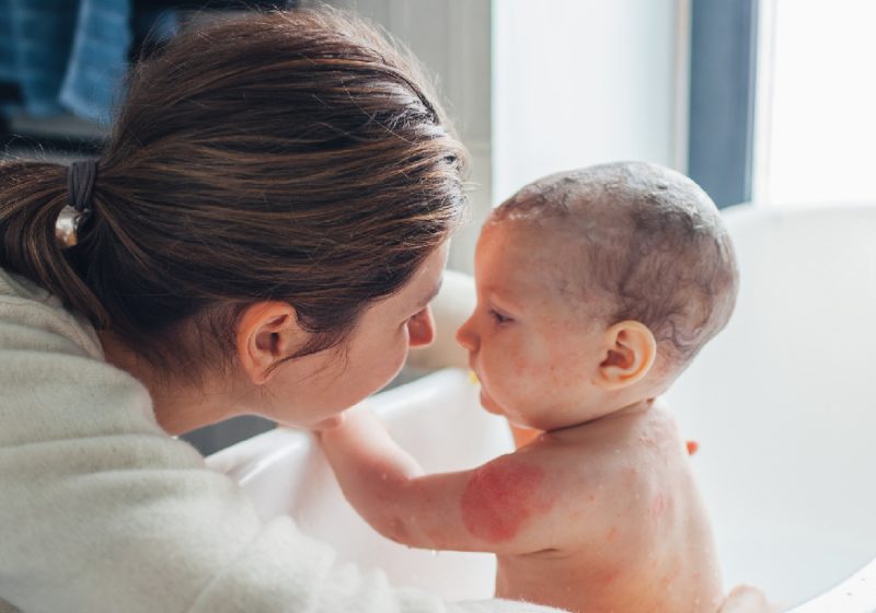Neurodermitis bei Kindern