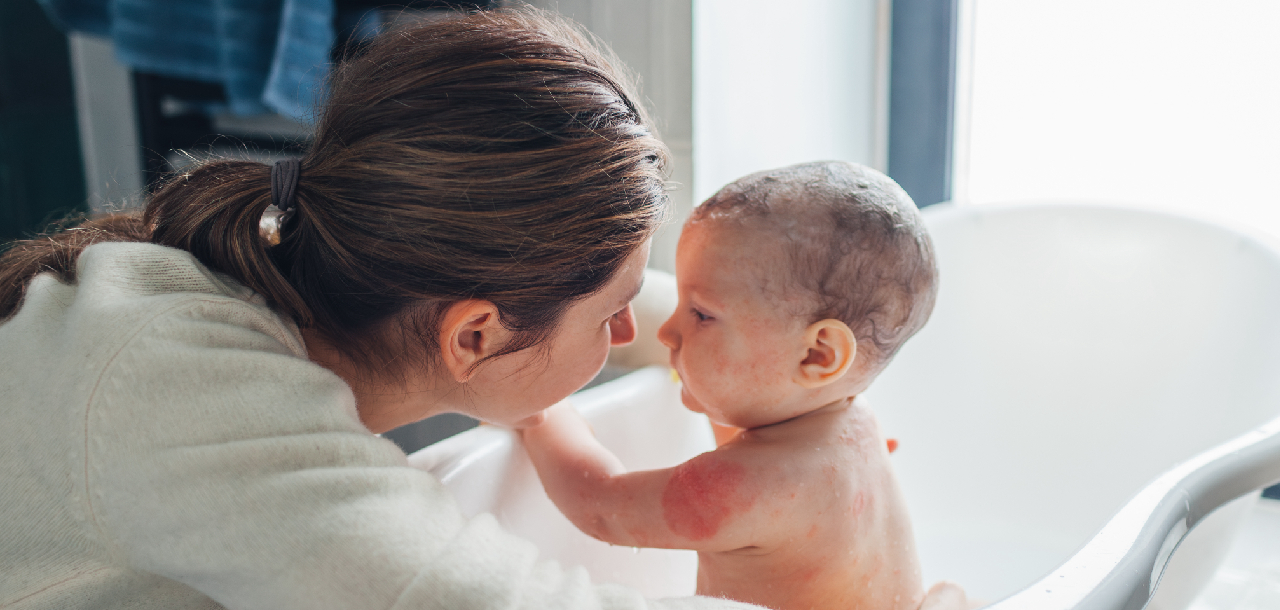 Neurodermitis bei Kindern